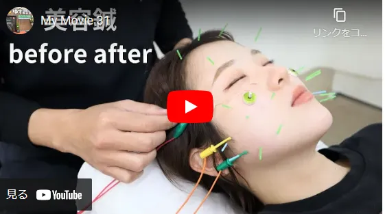 美容鍼効果