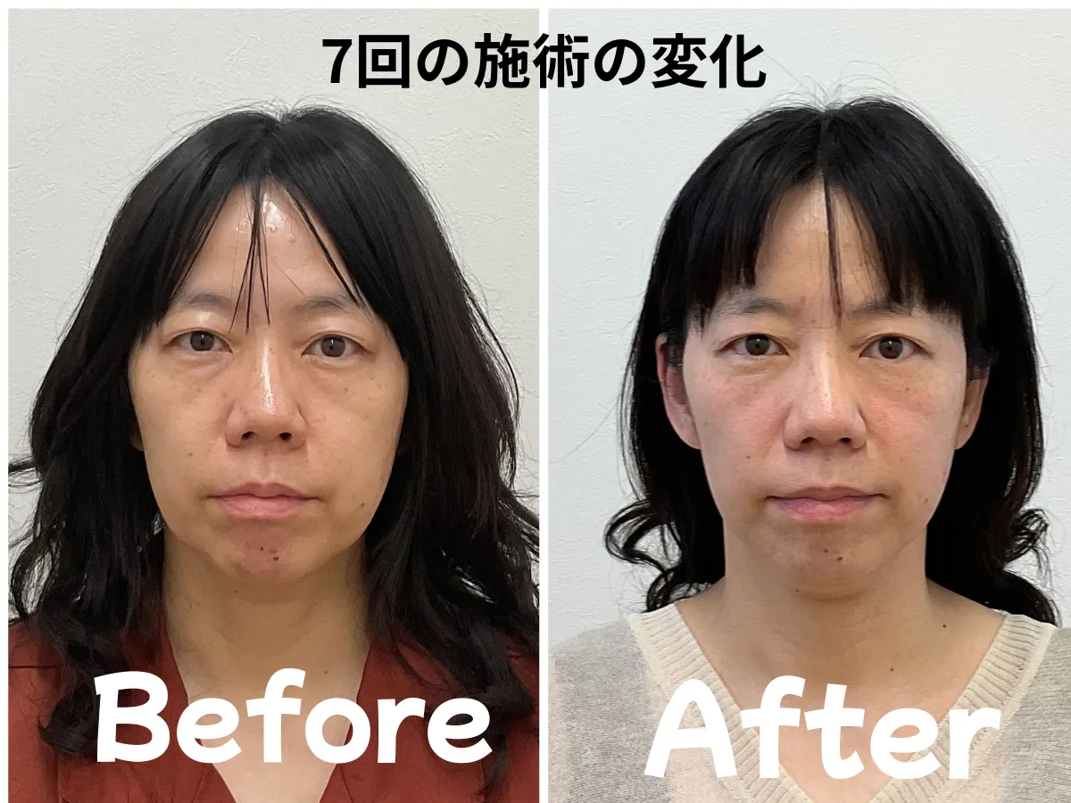 松本市ゆず鍼灸整骨院の美容鍼による50代女性の7回施術後ビフォーアフター。小顔・リフトアップ・肌質改善の症例。