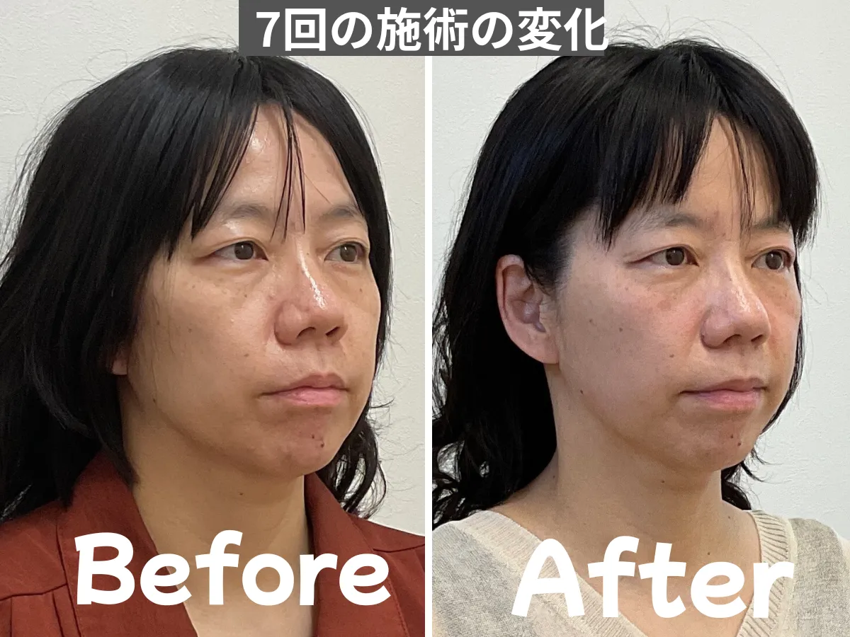 松本市ゆず鍼灸整骨院の美容鍼による50代女性の7回施術後ビフォーアフター。小顔・リフトアップ・肌質改善の症例。