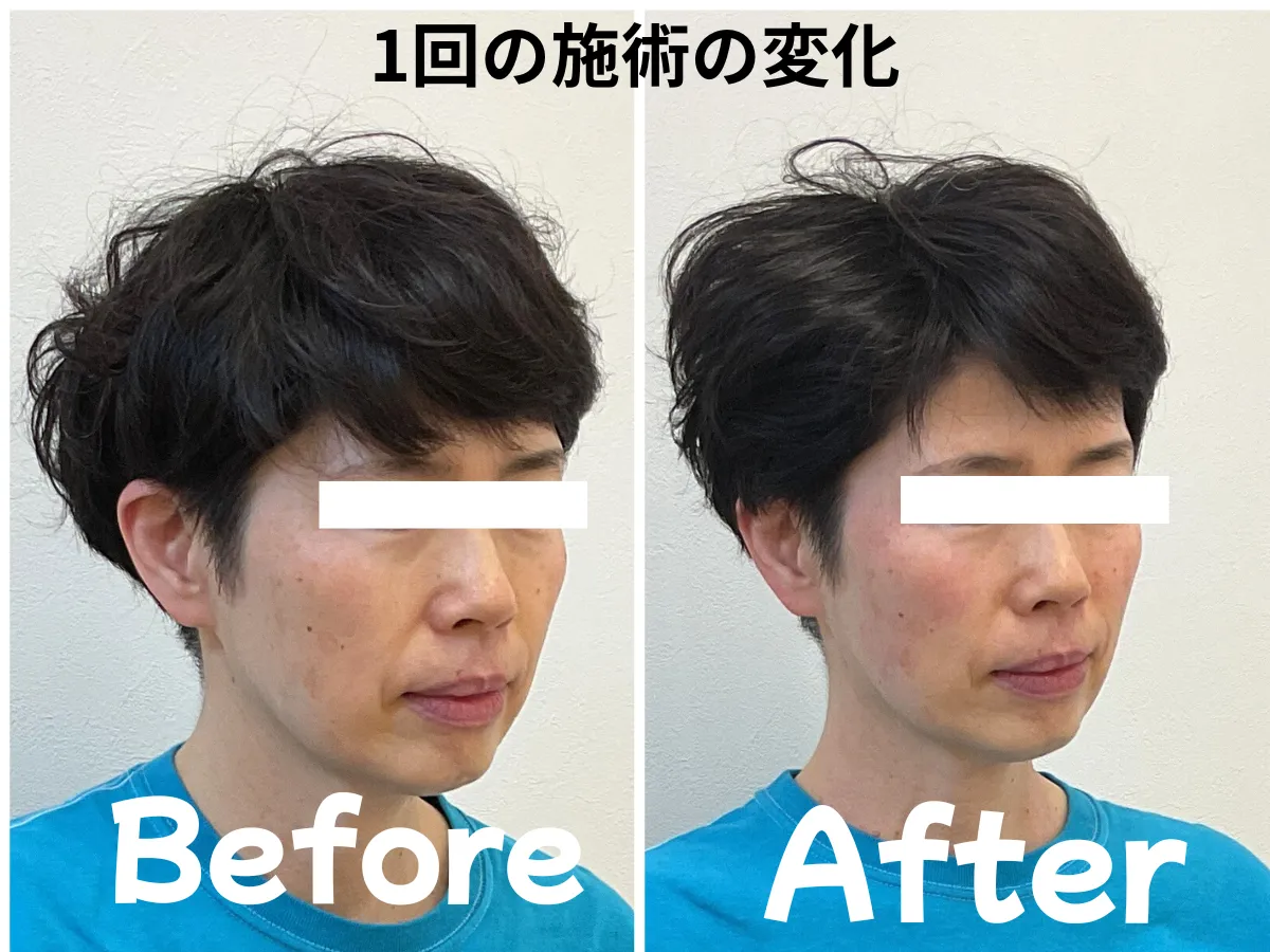 松本市美容鍼での変化